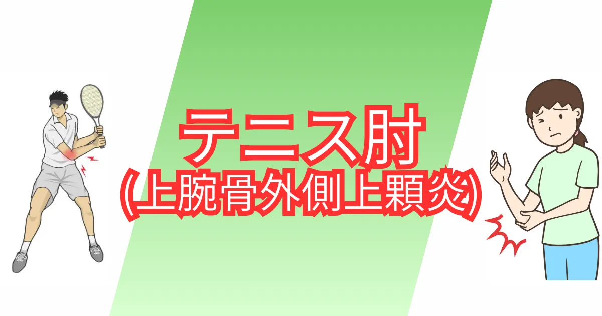テニス肘(上腕骨外側上顆炎)のサムネイル