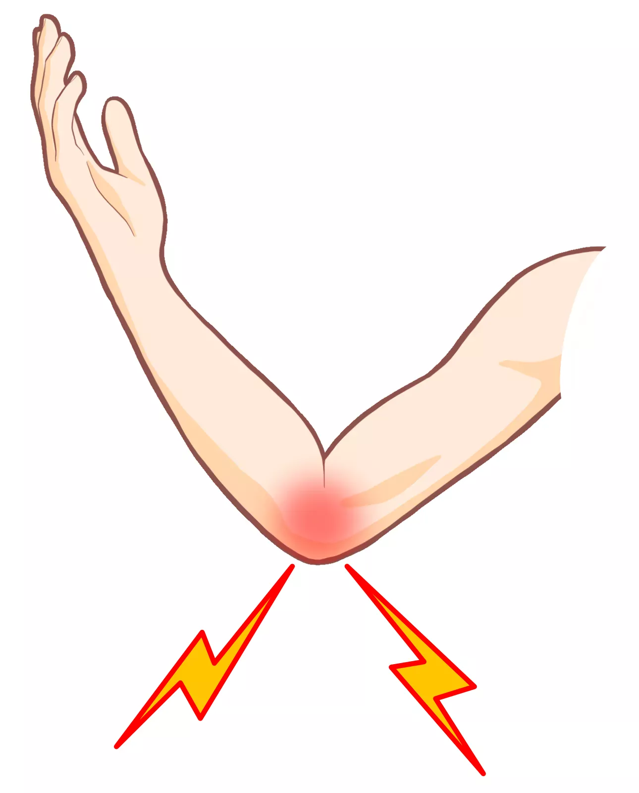 上腕骨内側上顆炎の図